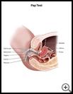 Thumbnail image of: Pap Test: Illustration