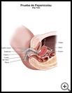 Thumbnail image of: Pap Test: Illustration