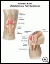 Thumbnail image of: Runner’s Knee (Patellofemoral Pain Syndrome): Illustration