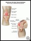 Thumbnail image of: Runner's Knee: Illustration