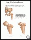 Thumbnail image of: Legg-Calve-Perthes Disease: Illustration