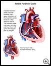 Thumbnail image of: Patent Foramen Ovale: Illustration