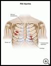 Thumbnail image of: Rib Injuries: Illustration