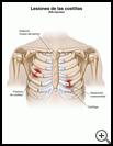 Thumbnail image of: Rib Injuries: Illustration