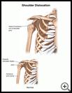 Thumbnail image of: Shoulder Dislocation: Illustration