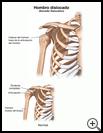 Thumbnail image of: Shoulder Dislocation: Illustration