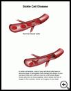 Thumbnail image of: Sickle Cell Anemia: Illustration