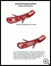Thumbnail image of: Sickle Cell Anemia: Illustration