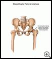 Thumbnail image of: Slipped Capital Femoral Epiphysis: Illustration