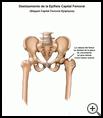 Thumbnail image of: Slipped Capital Femoral Epiphysis: Illustration