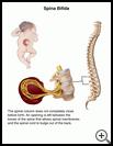 Thumbnail image of: Spina Bifida: Illustration