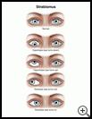 Thumbnail image of: Strabismus: Illustration