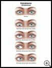 Thumbnail image of: Strabismus: Illustration