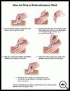 Thumbnail image of: Subcutaneous Shot, How to Give: Illustration