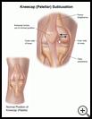 Thumbnail image of: Kneecap (Patellar) Subluxation: Illustration