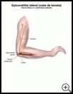 Thumbnail image of: Tennis Elbow: Illustration