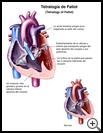 Thumbnail image of: Tetralogy of Fallot: Illustration