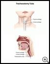 Thumbnail image of: Tracheostomy Tube: Illustration