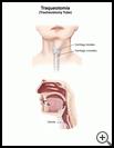 Thumbnail image of: Tracheostomy Tube: Illustration