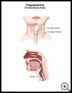 Thumbnail image of: Tracheostomy Tube: Illustration