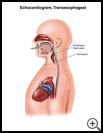 Thumbnail image of: Echocardiogram, Transesophageal: Illustration