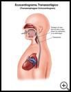 Thumbnail image of: Echocardiogram, Transesophageal: Illustration