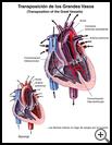 Thumbnail image of: Transposition of the Great Vessels: Illustration