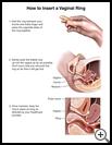 Thumbnail image of: Vaginal Contraceptive Ring, How to Insert: Illustration