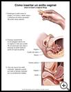 Thumbnail image of: Vaginal Contraceptive Ring, How to Insert: Illustration