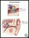 Thumbnail image of: Ventilation Tube: Illustration