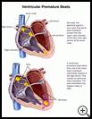 Thumbnail image of: Ventricular Premature Beats: Illustration