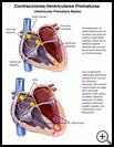 Thumbnail image of: Ventricular Premature Beats: Illustration