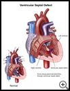 Thumbnail image of: Ventricular Septal Defect: Illustration