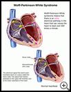 Thumbnail image of: Wolff-Parkinson-White Syndrome: Illustration