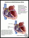 Thumbnail image of: Wolff-Parkinson-White Syndrome: Illustration