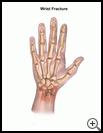 Thumbnail image of: Wrist Fracture: Illustration