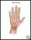 Thumbnail image of: Wrist Fracture: Illustration