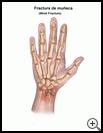 Thumbnail image of: Wrist Fracture: Illustration