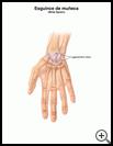 Thumbnail image of: Wrist Sprain: Illustration