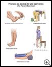 Thumbnail image of: Toe Fracture Exercises: Illustration