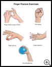 Thumbnail image of: Finger Fracture Exercises: Illustration
