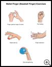 Thumbnail image of: Mallet Finger (Baseball Finger) Exercises: Illustration