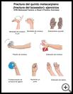 Thumbnail image of: Hand Fracture: Fifth Metacarpal (Boxer's) Fracture Exercises: Illustration