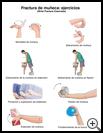 Thumbnail image of: Wrist Fracture Exercises: Illustration