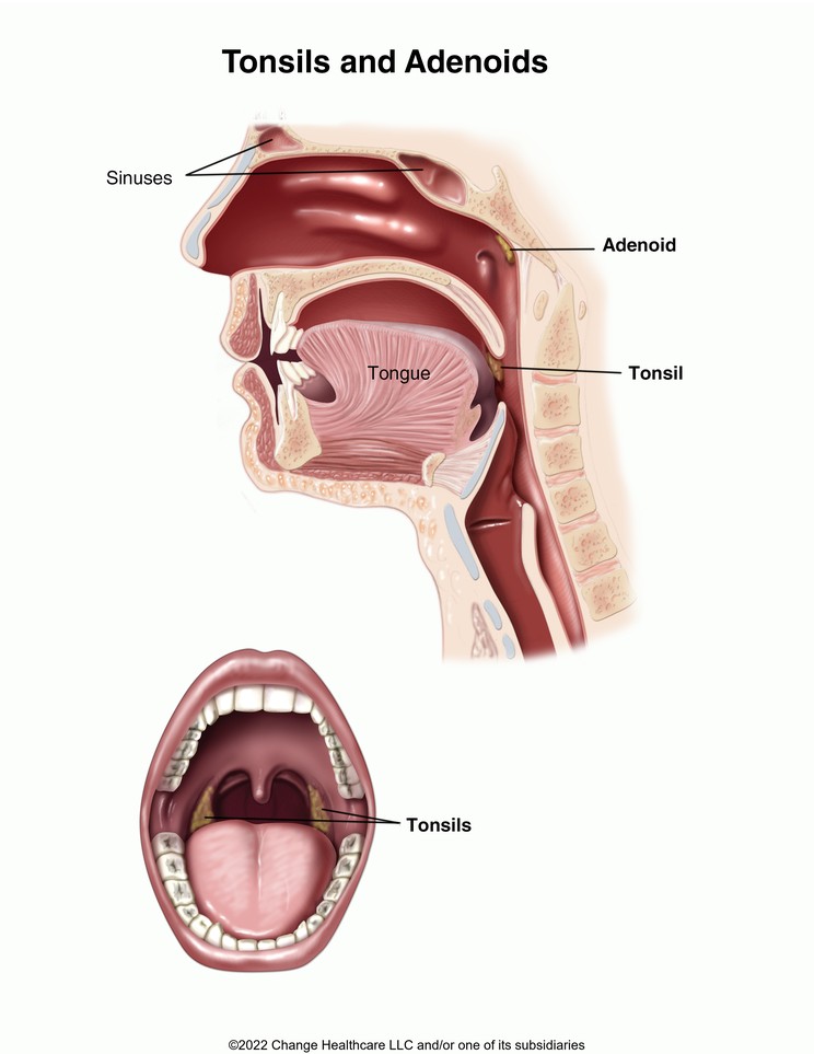 Tonsils and Adenoids: Illustration