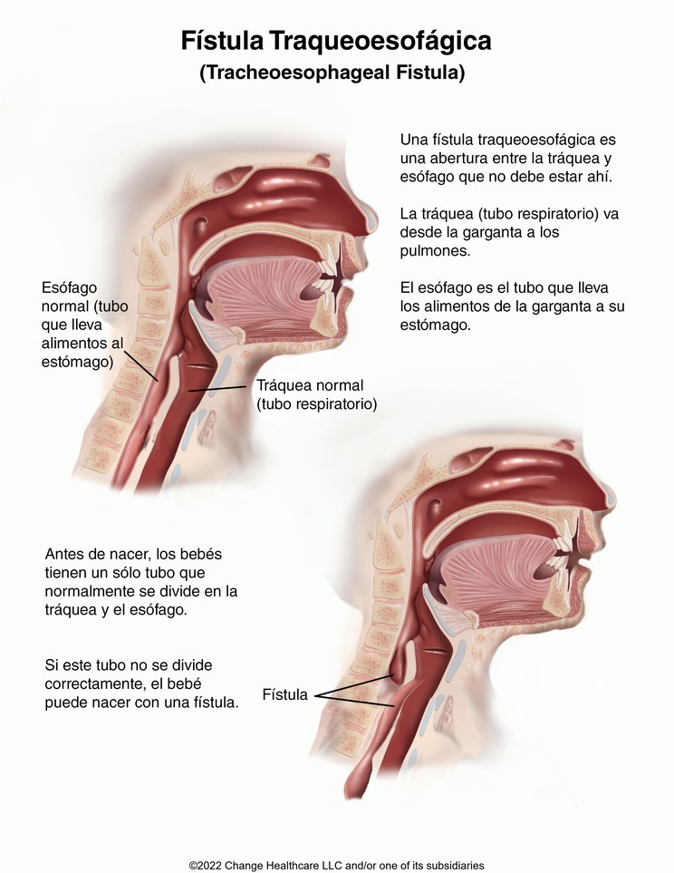 Tracheoesophageal Fistula in Children: Illustration