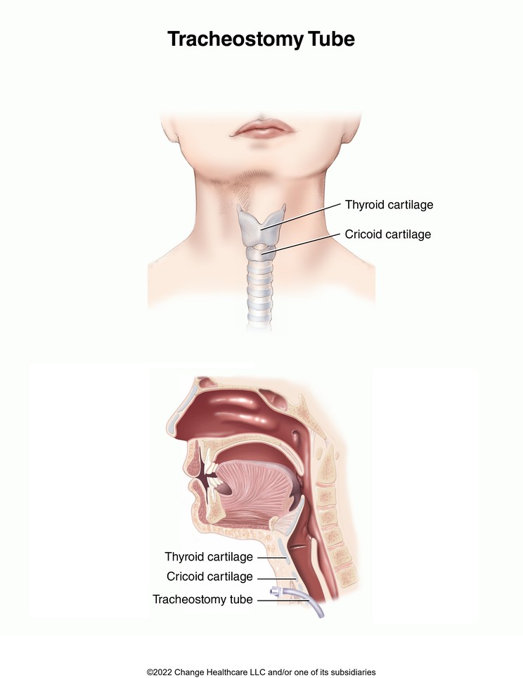 Tracheostomy Tube: Illustration