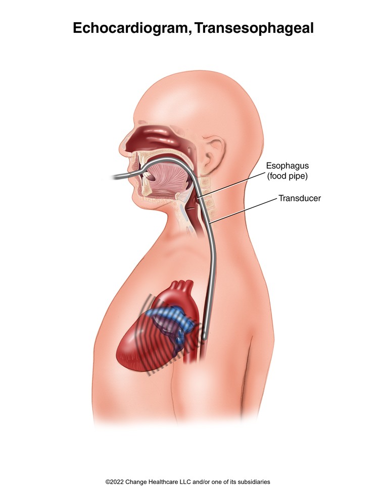 Echocardiogram, Transesophageal: Illustration