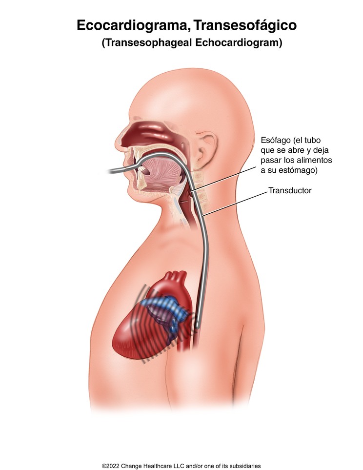 Echocardiogram, Transesophageal: Illustration