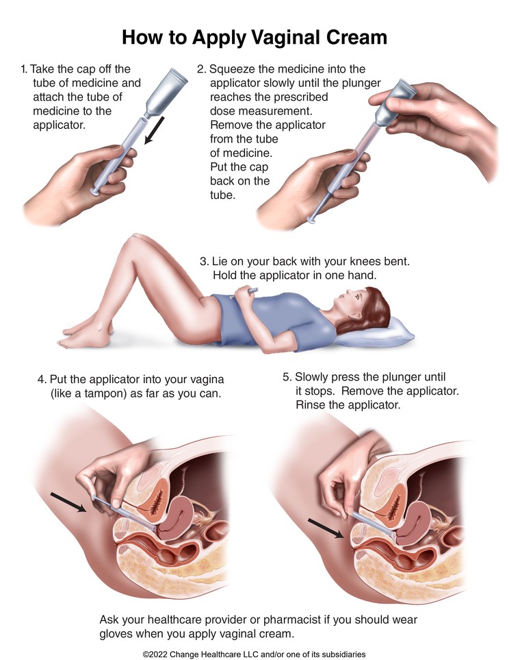 Vaginal Cream, How to Use: Illustration